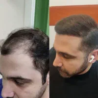 کاشت مو طبیعی / تراکم بالا طبیعی ۱۰ میلیون تخفیف