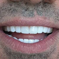 کامپوزیت دندان و تمام خدمات درمانی دندان