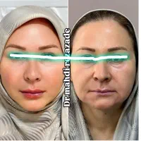 جراحی زیبایی، ساکشن|خدمات آرایشگری و زیبایی|مشهد, هفت تیر (حافظ)|دیوار