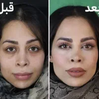 جشنواره پاییزه بلفاروپلاستی|خدمات آرایشگری و زیبایی|تهران, پاسداران|دیوار