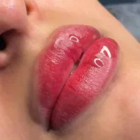 میکروبلیدینگ و فیبروز،بن مژه،شیدلب