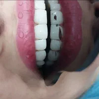 کامپوزیت دندان با جرمگیری و پالیش در اهواز