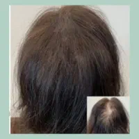 میکرواسکالپ سر|خدمات آرایشگری و زیبایی|گرگان, |دیوار