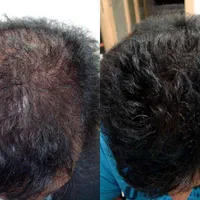 بوتاکس رایگان تضمینی هدیه ما