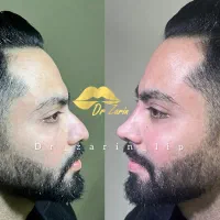 ژل لب روسی متدMمادلینگ خط لبخندفیلربینی گونه شقیقه