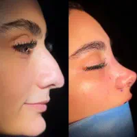 آف ویژه عمل زیبایی بینی ۱۹ میلیون|خدمات آرایشگری و زیبایی|شوش, |دیوار