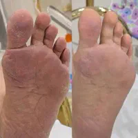 رفع ترک پا، خشکی پا (پدیکور حرفه ای)|خدمات آرایشگری و زیبایی|تهران, سلسبیل جنوبی|دیوار