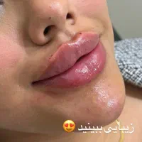 جشنواره مدل فیلر لب و نواحی مختلف صورت هر سیسی ۳۵۰