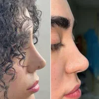 عمل بینی ترمیمی/گوشتی/بلفارو/کاشت ابرو/غبغب