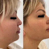 لیفت و جوانسازی پوست (هایفوتراپی--فیشیال)|خدمات آرایشگری و زیبایی|کرج, باغستان|دیوار
