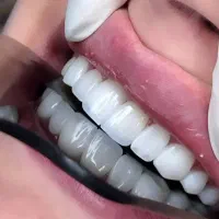 ایمپلنت/لمینیت/کامپوزیت بااقساط ویژه
