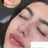 فیلر و بوتاکس تخفیف باورنکردنی  به مدت یک هفته