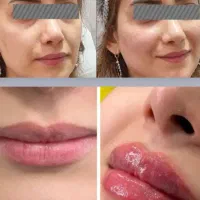 مدل جهت تزریق ژل و بوتاکس و تاتو