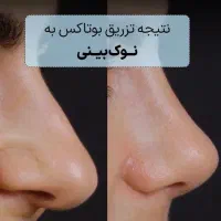 رینوپلاستی کوچککردن پره بینی بدون جراحی قوزوانحراف