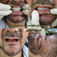 دندان ،دندان سازی ،دندان مصنوعی ،جوان پسند،اقساطی|خدمات آرایشگری و زیبایی|مشهد, شاهد (شهرک غرب)|دیوار