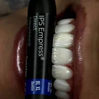 کامپوزیت لمینت روکش