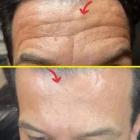 درمان چین و چروک و جوانسازی تضمینی