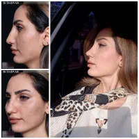 جشنواره جراحی بینی فولادشهر و فلاورجان|خدمات آرایشگری و زیبایی|فولادشهر, B4|دیوار