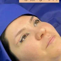 لیپو ساکشن ابدو عمل بینی  لیفت اموزش