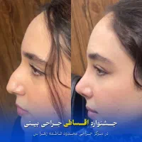 جراحی بینی با پیش پرداخت 5میلیون+اقساط