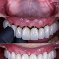 دندانپزشکی ایمپلنت کره فقط ۲۴ تومن با اقساط بلند