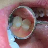 ترمیم و عصب کشی دندان تعرفه بسیار پایین  قصردشت