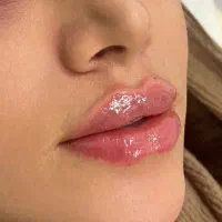 تزریق فیلر‌بوتاکس‌لطفا توضیحات بخونیدبعدپیام بدید