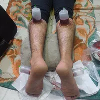 حجامت،زالودرمانی،فصد،برداشت خال و زگیل،در کل شهر|خدمات آرایشگری و زیبایی|مشهد, الهیه|دیوار