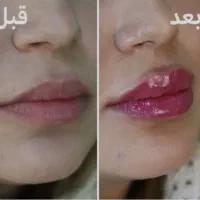 ژل لب،چونه ،آنزیم ،زاویه ،بوتاکس|خدمات آرایشگری و زیبایی|قم, تولید دارو و یخچال|دیوار