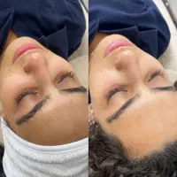 تخفیف فشیال و پاکسازی صورت
