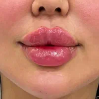 ژل لب بوتاکس مزوژل فیلربادی انزیم توسط پزشک فقط۸۹۹|خدمات زیبایی و سلامت|تهران, نارمک|دیوار