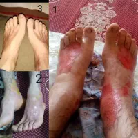 پمادسوختگی وضدلک۱۰۰٪تضمینی