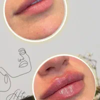 تزریق ژل،لیزر،بوتاکس|خدمات آرایشگری و زیبایی|تهران, یافت‌آباد|دیوار