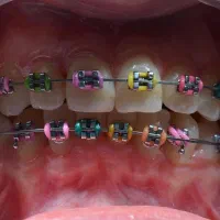 ارتودنسی ثابت و متحرک با اقساط بلند مدت|خدمات آرایشگری و زیبایی|آذرشهر, |دیوار