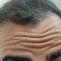 خدمات زیبایی فیلر و بوتاکس