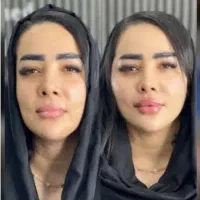 تزریق ژل/فیلر فقط تا آخرماه (جشنواره)درمطب فقط599ت|خدمات آرایشگری و زیبایی|اصفهان, باغ زیار|دیوار