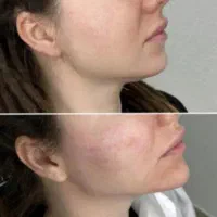 تزریق ژل وبوتاکس(سی سی ۵۰۰)ارایش دائم صورت،پیرسینگ|خدمات آرایشگری و زیبایی|آزادشهر, |دیوار