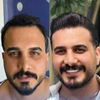 کاشت تخصصی و فول تراکم مو باشرایط نقدواقساط