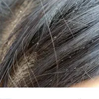 داروی صدرصد گیاهی رشکو و شپش|آرایشی، بهداشتی، درمانی|الوند, |دیوار