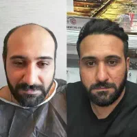 کاشت مو و ابرو، مزو و پی ار پی