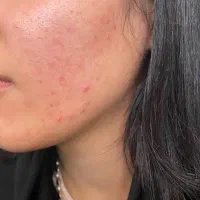 فیشیال و پاکسازی پوست|خدمات آرایشگری و زیبایی|ساری, |دیوار