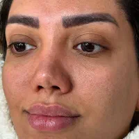 فیشال تخصصی زیر نظر پزشک|خدمات آرایشگری و زیبایی|مسجد سلیمان, |دیوار