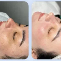 مزووایت سفیدی صورت