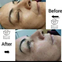 فیشال تخصصی، برداشت خال و ککو مک، ژل و بوتاکس|خدمات آرایشگری و زیبایی|شاهرود, |دیوار