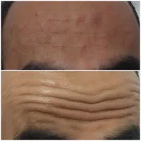 تخفیف ویژه‌ی خدمات ژل و بوتاکس بع مدت محدود