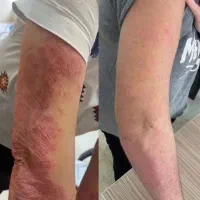 بهبود کامل پسوریازیس و اگزما از داخل بدن