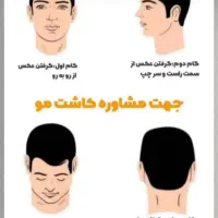 کاشت مو و ابرو