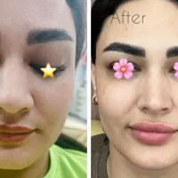 ژل بوتاکس کانتورینگ صورت آنزیم فیلر بینی مزوژل|خدمات آرایشگری و زیبایی|گرمسار, |دیوار