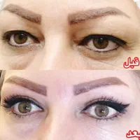 عمل بلفاروپلاستی درمان افتادگی پلک توسط متخصص چشم