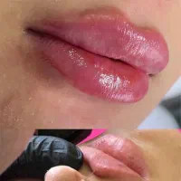 تخفیف تزریق ژل وبوتاکس درمطب پزشک فوق تخصص زیبایی